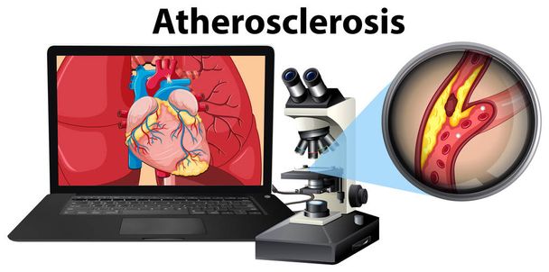 アテローム性動脈硬化のラップトップと顕微鏡の概念図 - ベクター画像