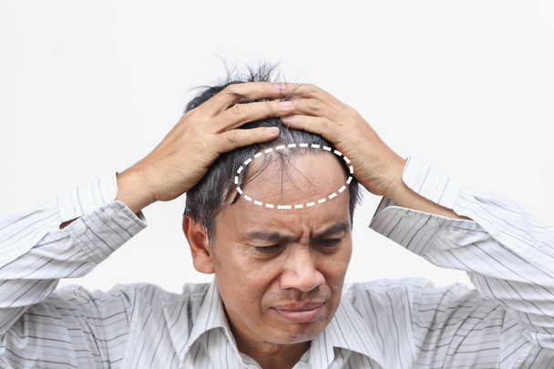 Облисіння (втрата волосся), що призвело до кризи середнього віку - Фото, зображення