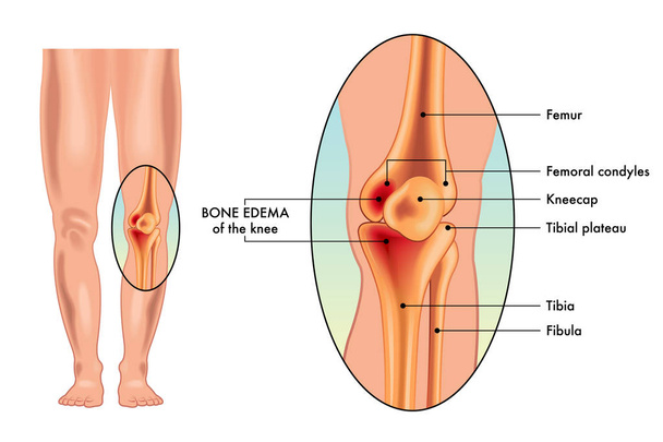 edema ósseo do poster médico do joelho
 - Vetor, Imagem
