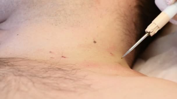 Conceito de cirurgia. Remoção de papilomas. Fecha. Médico removendo toupeira no procedimento cirúrgico, queimando-o com ferramentas médicas e equipamentos no corpo masculino
 - Filmagem, Vídeo