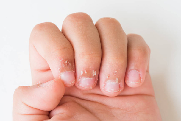 Bliska palce dziecka z sucha skóra, egzemy Dermatitis. Koncepcja Medycyna i ochrona zdrowia. - Zdjęcie, obraz