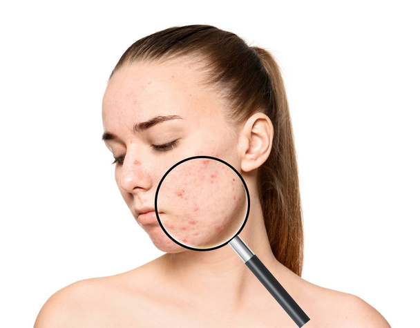 Magnifying young woman's skin with acne problem on white background - Foto, Imagem