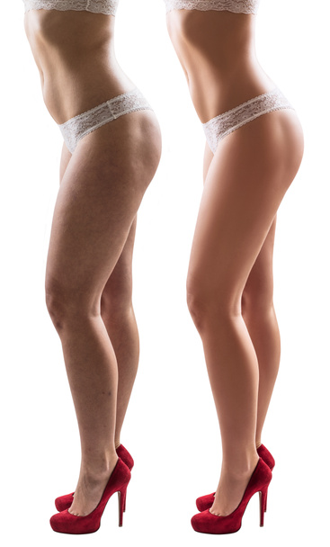 Жіночі ноги до і після лікування стану шкіри
. - Фото, зображення