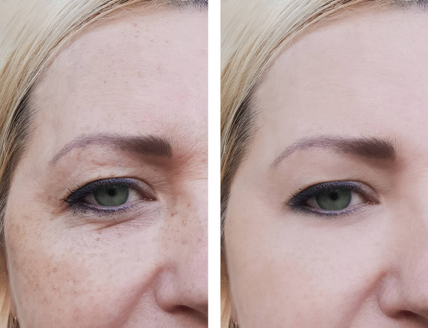 gezicht vrouw rimpels vóór en na de pigmentatie - Foto, afbeelding