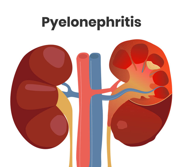 Illustration der akuten Pyelonephritis mit Eiter in der Niere und schwerer Entzündung. Die normale Niere befindet sich links, die betroffene Niere rechts - Vektor, Bild