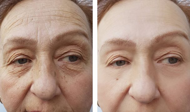 Ρυτίδες προσώπου από μια ηλικιωμένη γυναίκα, πριν και μετά από διαδικασίες - Φωτογραφία, εικόνα