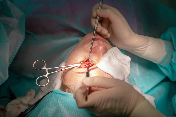 Πλαστική χειρουργική επέμβαση στο χειρουργείο - Φωτογραφία, εικόνα