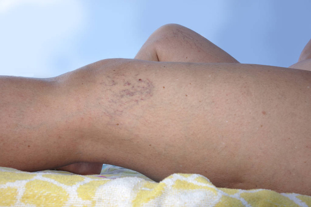 gezwollen bloedvaten op vrouwelijke volwassen benen - Foto, afbeelding
