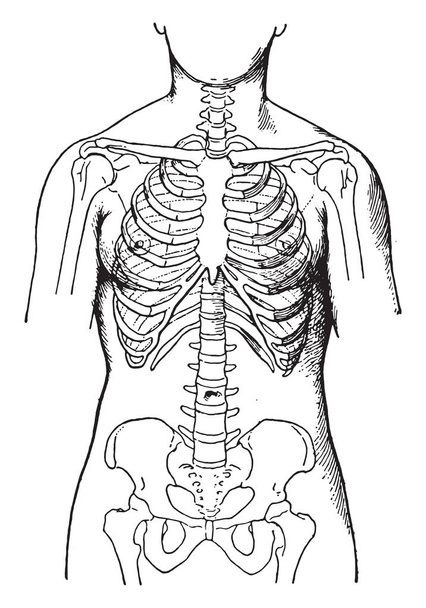 Deformované korzety, ukazuje stav kostí u žen, které obvykle nosí těsné korzety, vinobraní ryté ilustrace - Vektor, obrázek