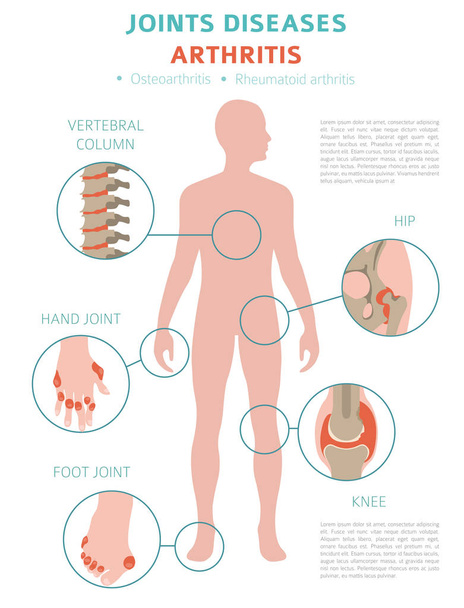 Болезни суставов. Симптомы артрита, набор икон лечения. Медицинский инфографический дизайн. Векторная иллюстрация
 - Вектор,изображение