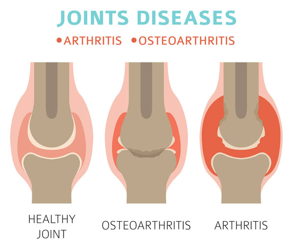 Enfermedades articulares. Artritis, síntomas de osteoartritis, conjunto de iconos de tratamiento. Diseño de infografía médica. Ilustración vectorial
 - Vector, imagen