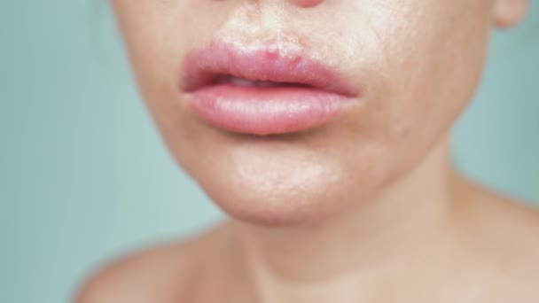 herpes on the female lips. 4k, close-up, blue background, blur, slow-motion - Video