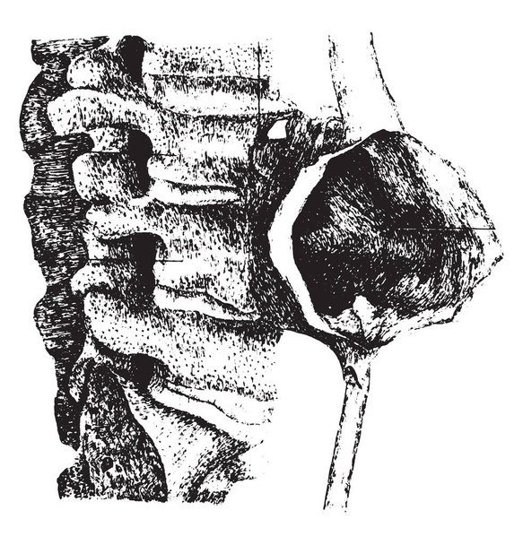 Aneurisma simétrico de la aorta abdominal, grabado vintage
. - Vector, Imagen