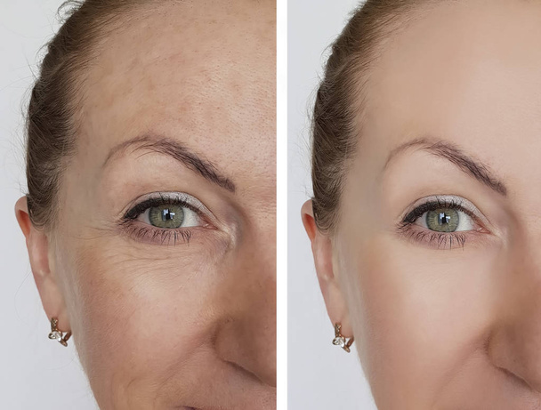 vrouw gezicht rimpels vóór en na cosmetische ingrepen - Foto, afbeelding