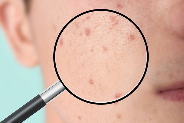 Magnifying young man's skin with acne problem, closeup - Fotó, kép