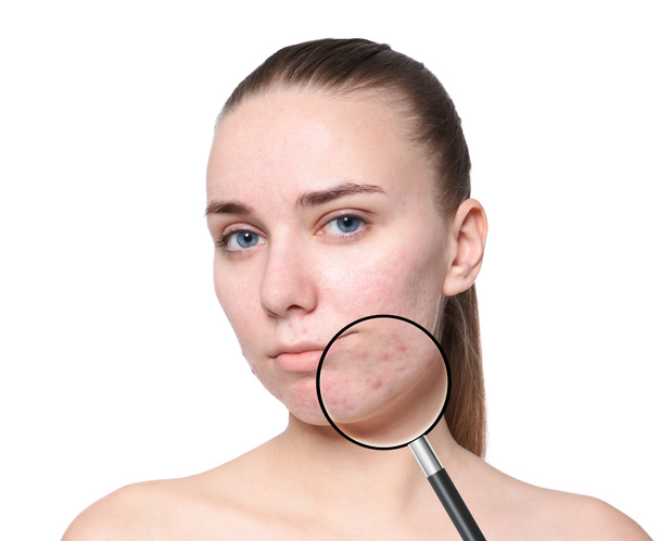 Magnifying young woman's skin with acne problem on white background - Φωτογραφία, εικόνα