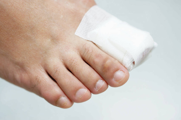 Unha grande do dedo do pé ferida por gaze e pele seca no backgrouond branco
. - Foto, Imagem