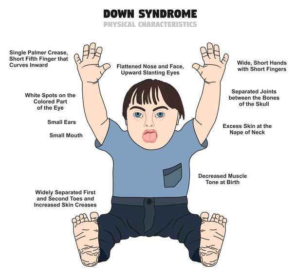 Síndrome de Down Características Físicas diagrama infográfico mostrando criança afetada nascida com esta deficiência para cuidados de saúde da ciência médica e conscientização das pessoas
 - Vetor, Imagem