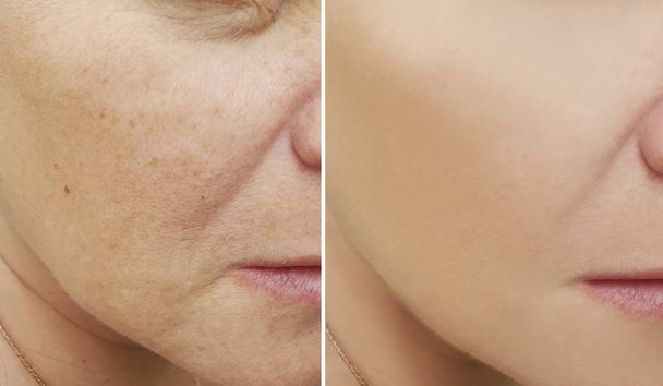 zmarszczki twarzy kobieta przed i po zabiegach - Zdjęcie, obraz