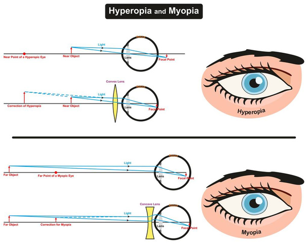 Diagrama infográfico de hiperopía y miopía que muestra la comparación entre ellos, incluidos los puntos focales de objetos lejanos y cercanos retina ocular y lente convexa y cóncava de corrección para la educación en ciencias médicas y la atención sanitaria
 - Vector, Imagen