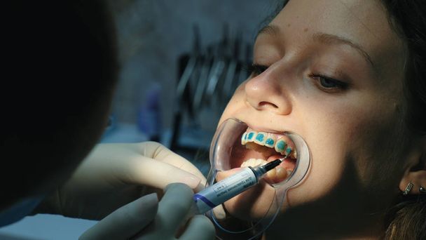 Tandarts geldt orthodontische blauwe lijm op de tanden aan de vrouw in de hendel voor de installatie van de beugel systeem close-up. Bezoek aan de stomatologist-orthodontist - Foto, afbeelding