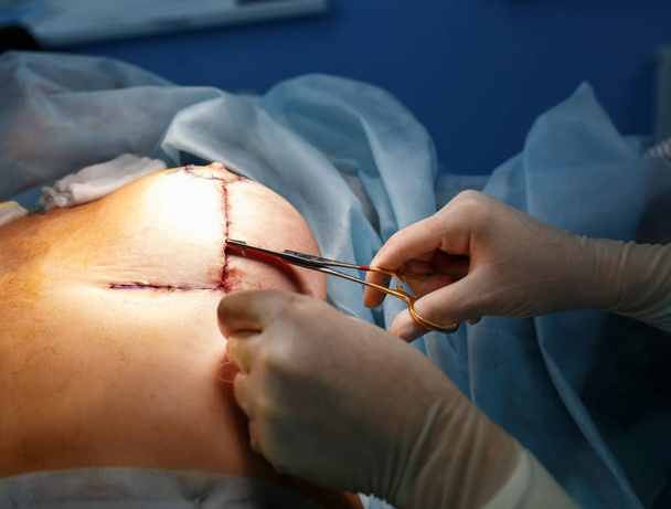 Opération rapprochée. Chirurgie d'augmentation mammaire en salle d'opération
 - Photo, image