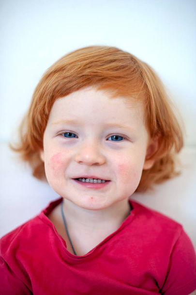 A child with signs of an allergy on the face - Photo, Image