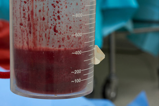 Een heleboel bloed in het een zuiging container tijdens de operatie in operatiekamer - Foto, afbeelding
