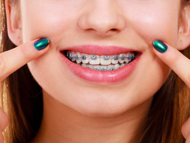 Dentist and orthodontist concept. Woman smile showing her white teeth with blue braces - Foto, immagini