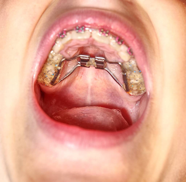 Paciente com quadro de expansão palatina de dentes superiores. Dentes de leite decíduos primários da criança
 - Foto, Imagem