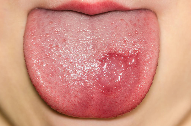 Географічна хвороба язика на кавказькій дитині
 - Фото, зображення