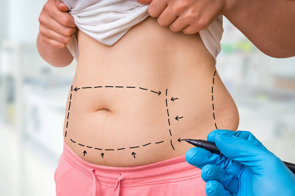 Plastiikkakirurgia lääkäri piirtää viivoja merkki potilaan vatsaan klinikalla
 - Valokuva, kuva