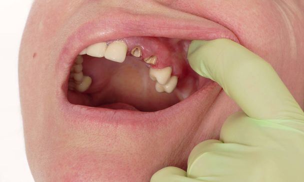 Gros plan de dent artificielle cassée et inflammation, gingivite
 - Photo, image