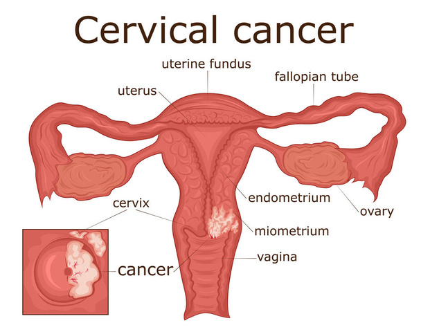 Illustrazione della malattia del sistema riproduttivo femminile - cancro del collo dell'utero
 - Vettoriali, immagini