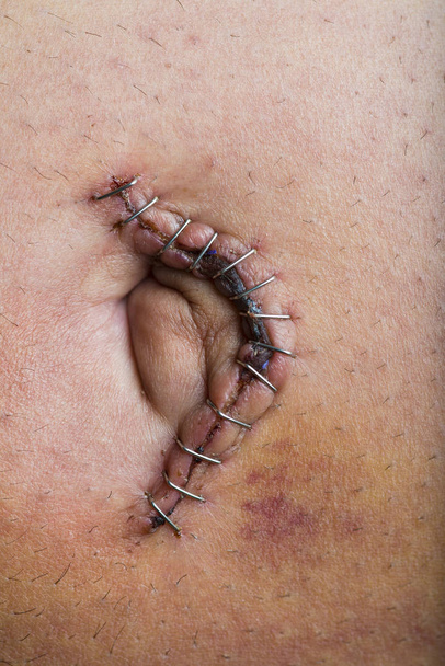 Operacja naprawy przepukliny pępkowej w dojrzałego mężczyzny - Zdjęcie, obraz