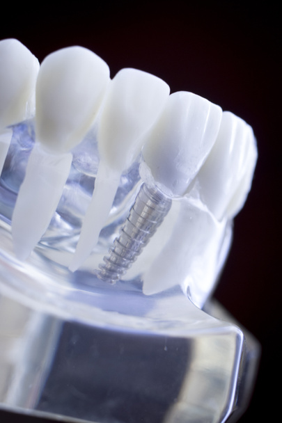 Dentist dental teeth teaching model showing titanium metal tooth implant screw. - Photo, Image
