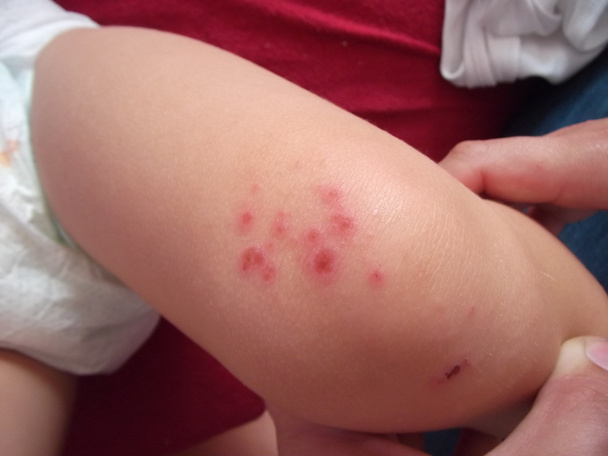 allerginen ihottuma pienen lapsen jalassa
 - Valokuva, kuva