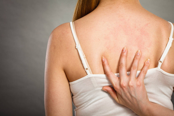 Health problem, skin diseases. Young woman showing her itchy back with allergy rash urticaria symptoms - Photo, Image