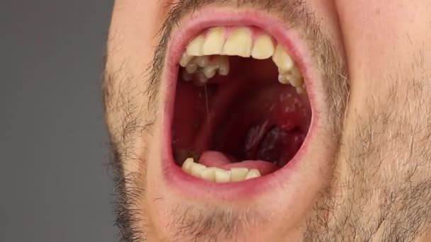 parrakas mies avaa suunsa lääkärintarkastusta tai hammastarkastusta varten, sivunäkymä, harmaa tausta, lähikuva
 - Materiaali, video