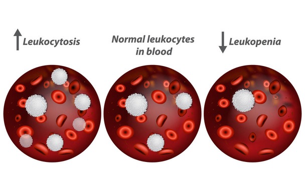 Leukocytose en leukopenie. Witte bloedcellen.  - Vector, afbeelding