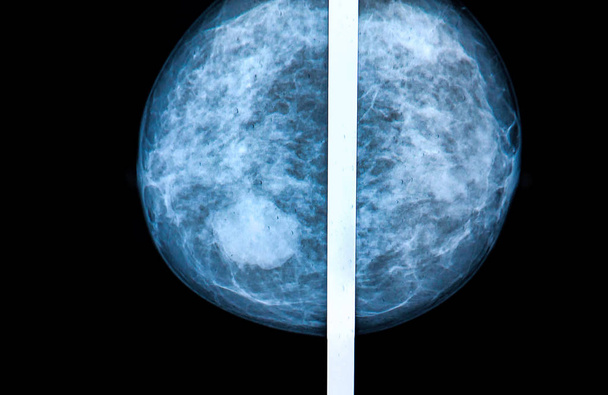 マンモグラフィ乳房 x 線画像をスキャンします。 - 写真・画像