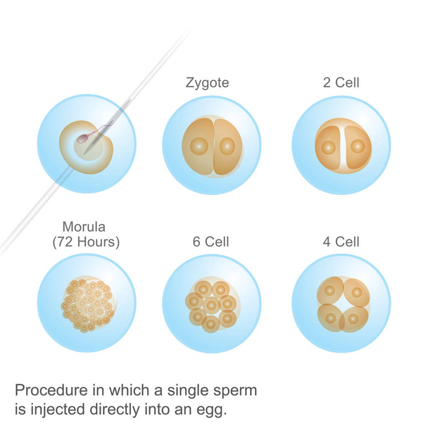 Folyamat, amely egyetlen spermium. Ábra anatómiai szervezet emberi. - Vektor, kép