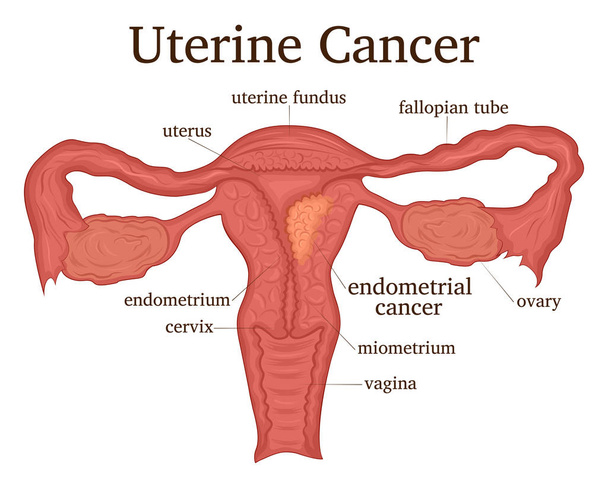 Kadın üreme sistemi hastalığı - rahim kanseri çizimi - Vektör, Görsel