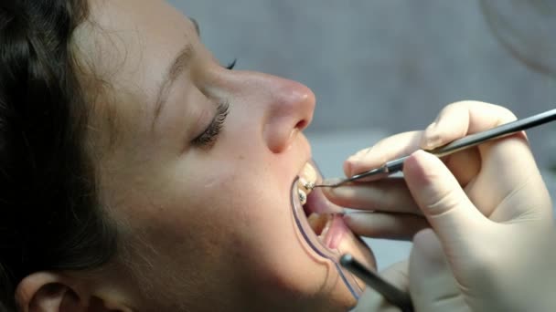 Zahnarztbesuch, Montage des Bracket-Systems und Korrektur des Fehlverschlusses. Kieferorthopäde korrigiert die eingesetzte Halterung und schaut in den Zahnspiegel aus nächster Nähe. - Filmmaterial, Video