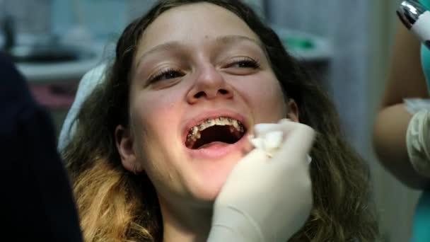 Abrazaderas de metal de cerca, visita al dentista. Ortodoncista completó la instalación
 - Metraje, vídeo