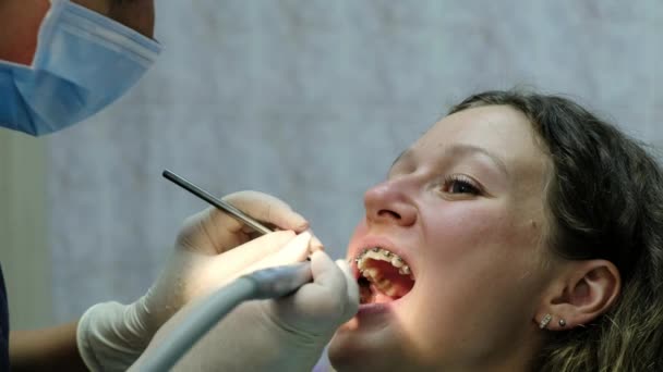 Visit to the dentist. Orthodontist drills and corrects the patch seal after installing the bracket system - Séquence, vidéo