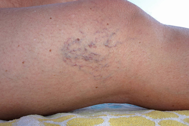 mature female varicose veins legs close up - Photo, Image