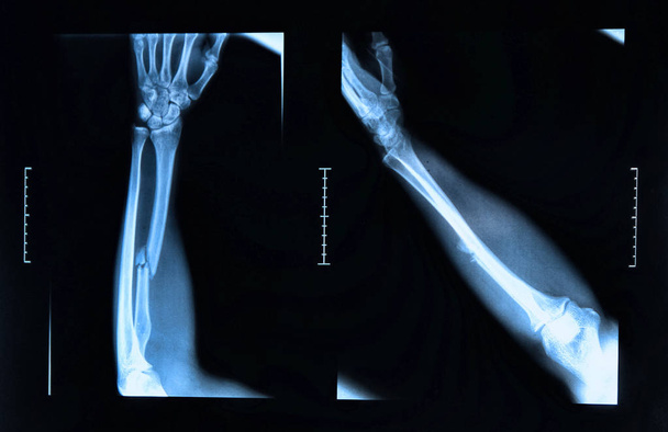 Röntgenbild zeigt Bruch des Radiusknochens - Foto, Bild