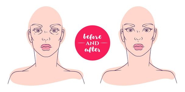 Naisen muotokuva ennen ja jälkeen kosmeettisten vikojen kanssa. Plastiikkakirurgia ja ulkonäön puutteiden korjaaminen. Blefaroplastiaa. Tyrä alaluomea
 - Vektori, kuva
