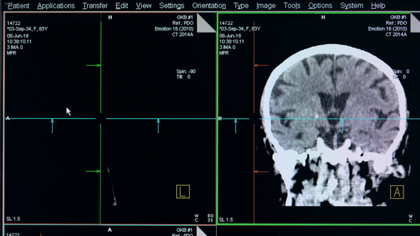 人間の脳のケースの描写がスキャン モニターに表示されています。 - 映像、動画